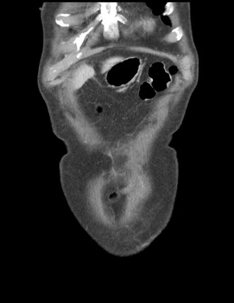 File:Abdominal wall metastasis from colorectal carcinoma (Radiopaedia 31016-31717 Coronal C+ portal venous phase 6).jpg