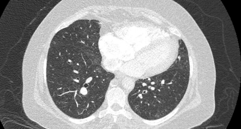 File:Accessory right inferior hepatic vein (Radiopaedia 65245-74259 Axial lung window 51).jpg
