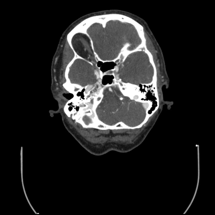 Acute M1 occlusion with ischemic penumbra (CT perfusion) (Radiopaedia 71897-82344 Axial C+ arterial phase thins 121).jpg