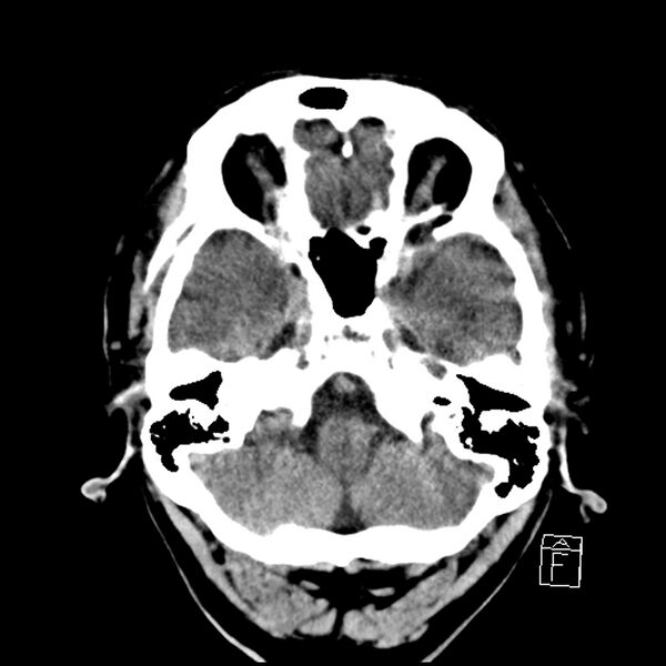 File:Acute P1 occlusion with PCA ischemia penumbra (CT perfusion) (Radiopaedia 72084-82586 Axial non-contrast 7).jpg