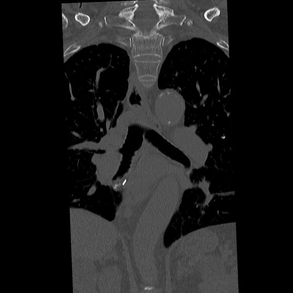 File:Acute and chronic vertebral compression fractures (Radiopaedia 31608-32494 Coronal bone window 9).jpg