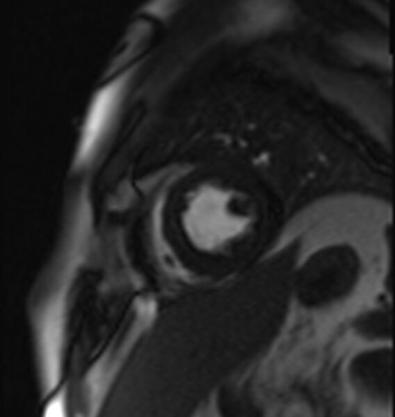 File:Acute anteroseptal myocardial infarction (Radiopaedia 68409-77945 Short axis (mid ventricular) Perfusion 9).jpg