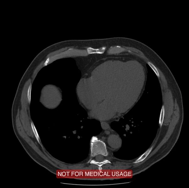 File:Acute aortic dissection - Stanford type A (Radiopaedia 40661-43285 Axial non-contrast 44).jpg