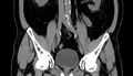 Acute appendicitis (Radiopaedia 13030-13091 Coronal non-contrast 14).jpg