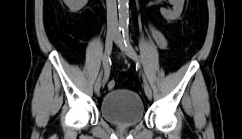 File:Acute appendicitis (Radiopaedia 13030-13091 Coronal non-contrast 14).jpg