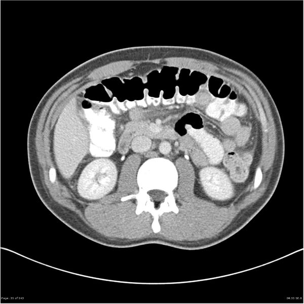 File:Acute appendicitis (Radiopaedia 25364-25615 B 25).jpg