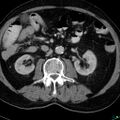 Acute appendicitis arising from a malrotated cecum (Radiopaedia 19970-19997 Axial C+ portal venous phase 12).jpg