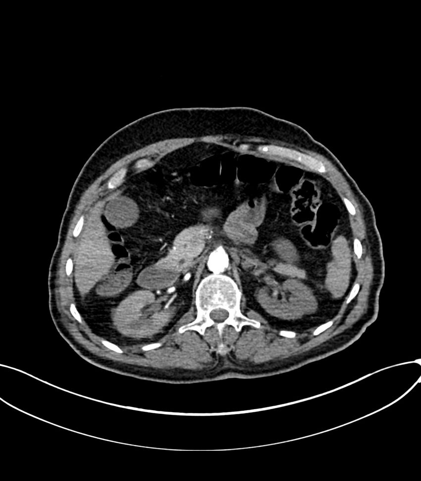 Acute arterial mesenteric ischemia (Radiopaedia 78238-90828 Axial C+ arterial phase 47).jpg