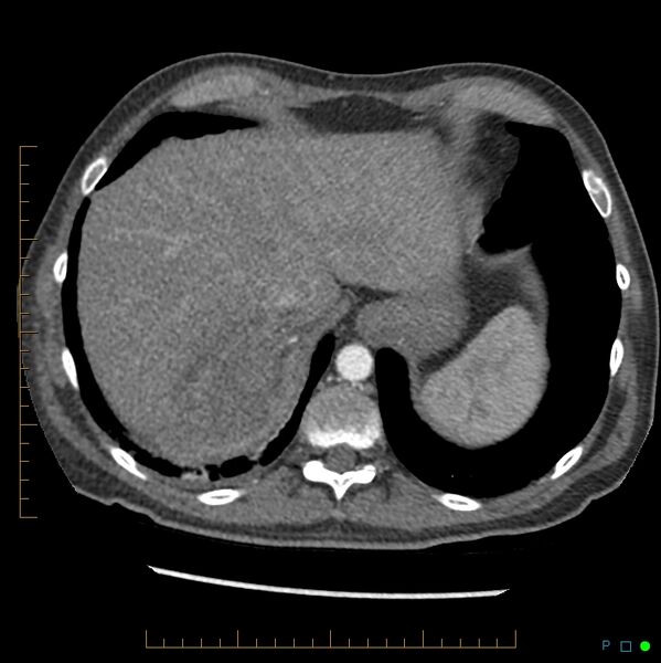 File:Acute hemorrhage into adrenal metastasis from NSCLC (Radiopaedia 43135-46429 Axial C+ arterial phase 4).jpg