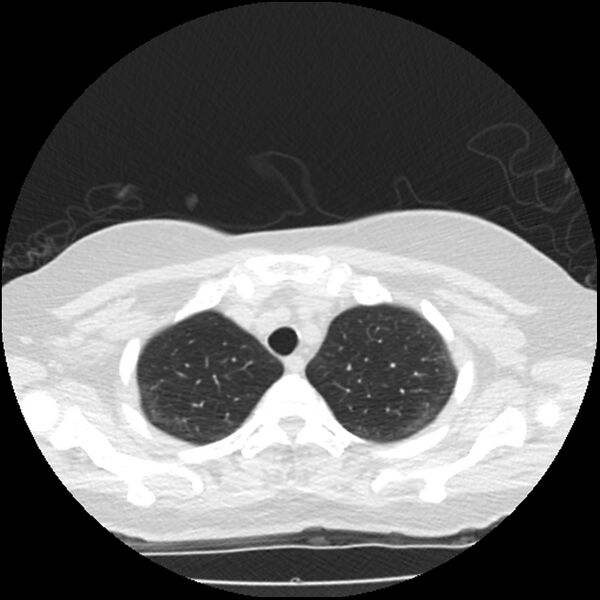 File:Acute interstitial pneumonitis (Radiopaedia 45404-49444 Axial lung window 17).jpg