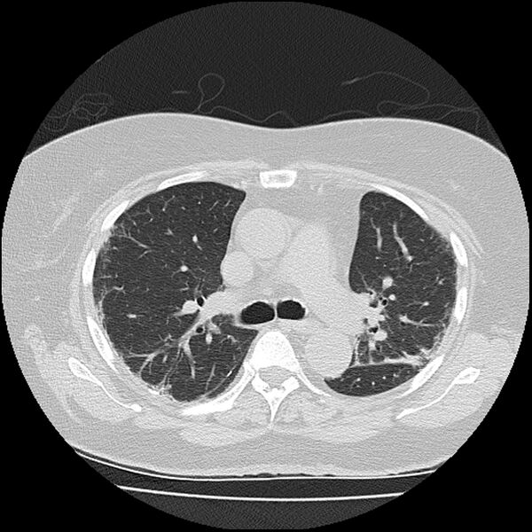 File:Acute interstitial pneumonitis (Radiopaedia 45404-49452 Axial lung window 38).jpg