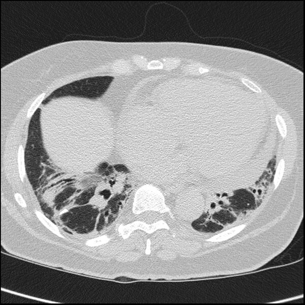 File:Acute interstitial pneumonitis (Radiopaedia 45404-49453 Axial lung window 56).jpg