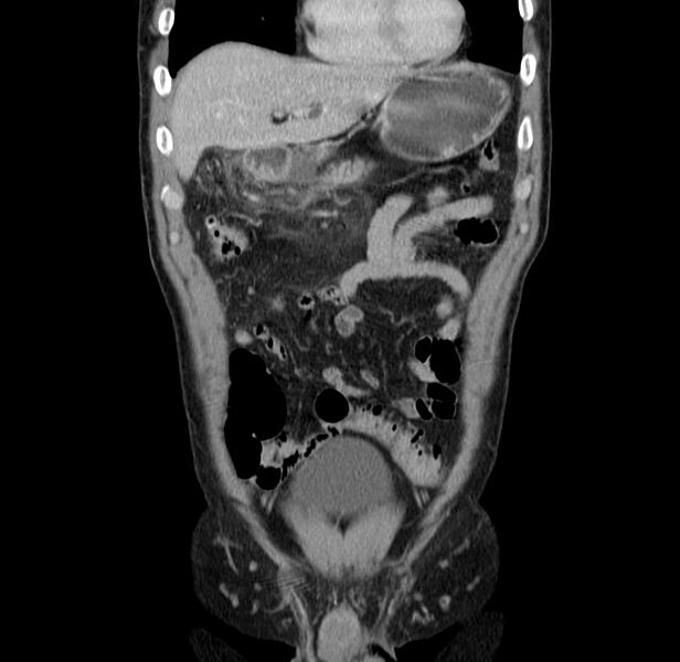 File:Acute pancreatitis (Radiopaedia 22572-22596 Coronal C+ portal venous phase 15).jpg