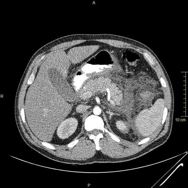 File:Acute pancreatitis (Radiopaedia 23231-23290 Axial C+ arterial phase 33).JPG