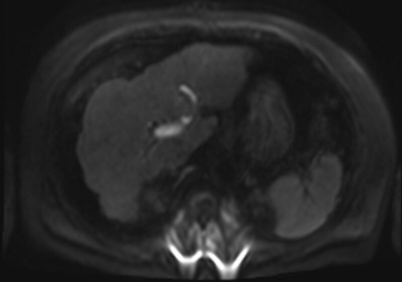 File:Acute portal vein thrombosis (Radiopaedia 73198-83925 Axial DWI 43).jpg