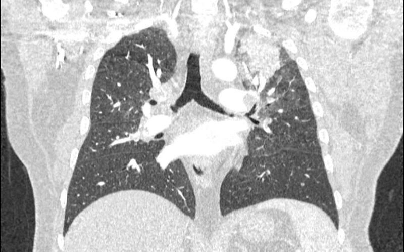 File:Acute pulmonary embolism with pulmonary infarcts (Radiopaedia 77688-89908 Coronal lung window 54).jpg
