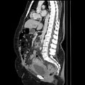 Acute pyelonephritis (Radiopaedia 25657-25837 Sagittal renal parenchymal phase 42).jpg