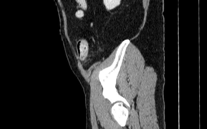 File:Acute sigmoid colon diverticulitis (Radiopaedia 55507-61976 Sagittal C+ portal venous phase 118).jpg