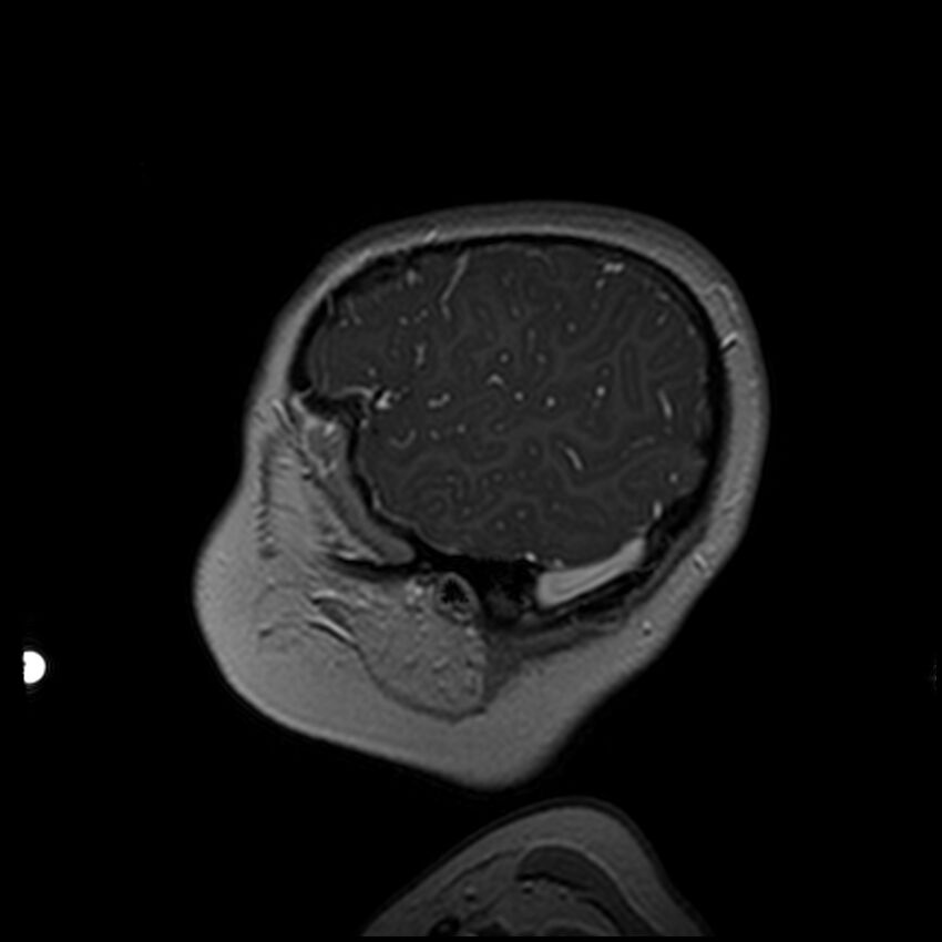 Adamantinomatous craniopharyngioma (Radiopaedia 77407-89529 H 16).jpg