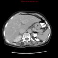 Adenocarcinoma of the colon (Radiopaedia 8191-9039 Axial renal excretory phase 6).jpg