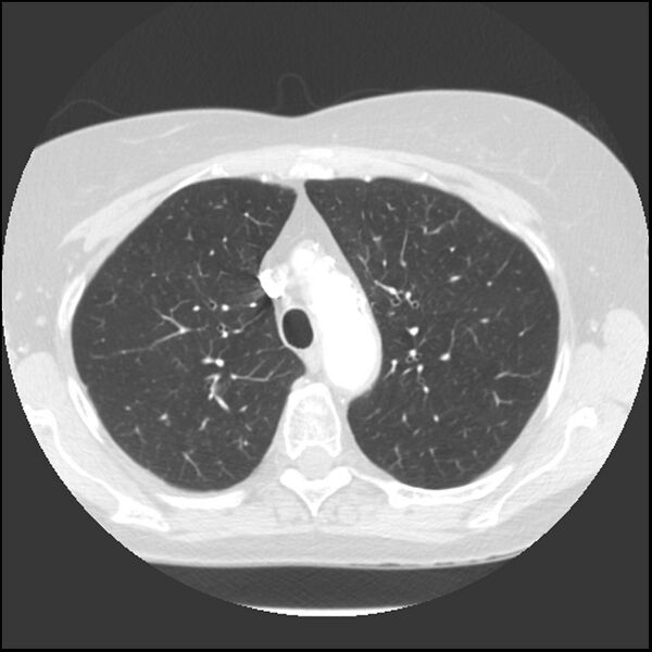 File:Adenocarcinoma of the lung (Radiopaedia 41015-43755 Axial lung window 34).jpg