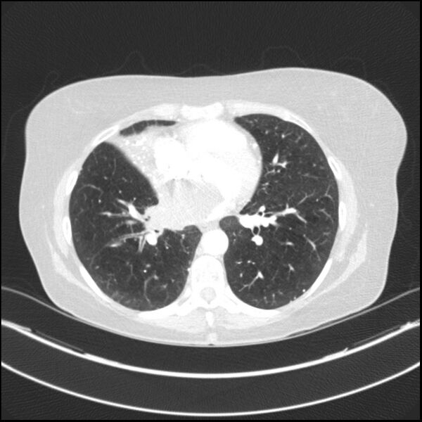 File:Adenocarcinoma of the lung (Radiopaedia 44205-47803 Axial lung window 56).jpg