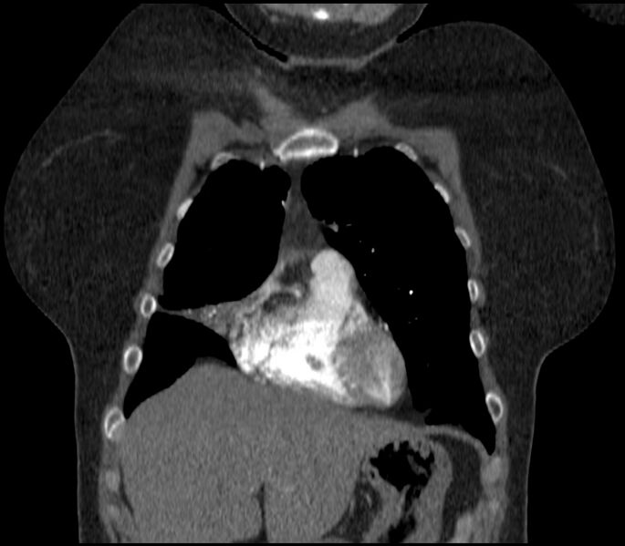 File:Adenocarcinoma of the lung (Radiopaedia 44205-47803 Coronal C+ portal venous phase 19).jpg
