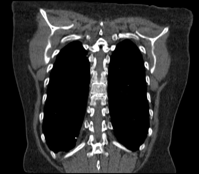 File:Adenocarcinoma of the lung (Radiopaedia 44205-47803 Coronal C+ portal venous phase 83).jpg