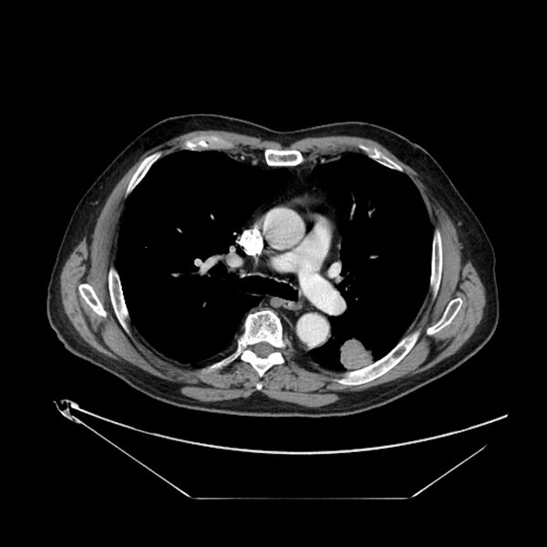 File:Adenocarcinoma of the lung (Radiopaedia 44876-48759 Axial C+ portal venous phase 37).jpg