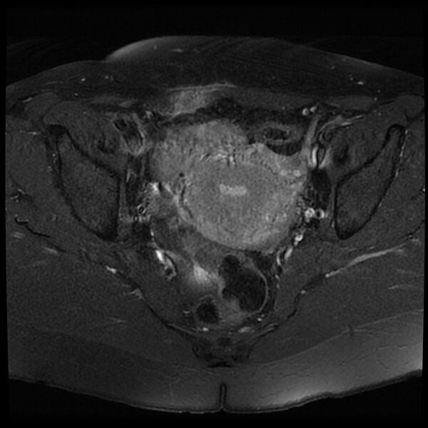 File:Adenomyosis-scar endometriosis (Radiopaedia 65863-75022 Axial T1 C+ fat sat 13).jpg