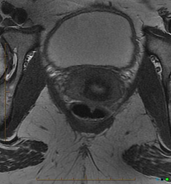 File:Adenomyosis uterus with hematometra (Radiopaedia 45779-50011 Axial T2 27).jpg