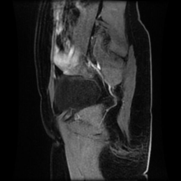 File:Adenomyosis within a septate uterus (Radiopaedia 69963-79981 Sagittal LAVA-Dyn 5).jpg