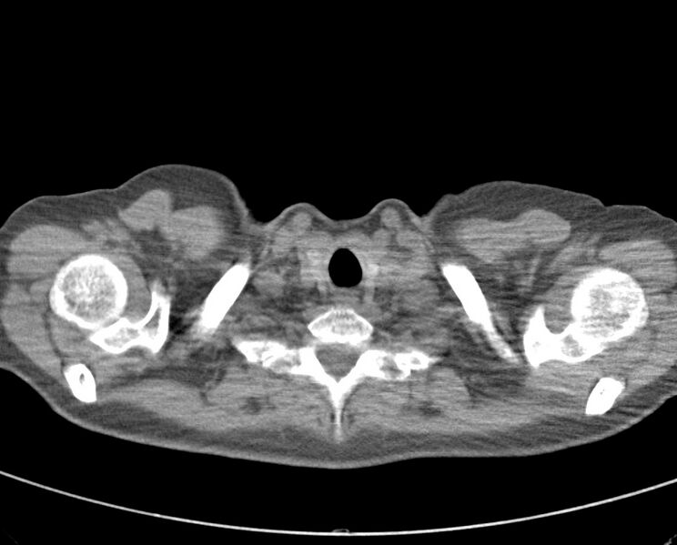 File:Adenosquamous lung carcinoma (Radiopaedia 22035-22030 non-contrast 10).jpg