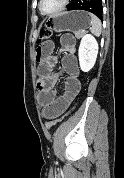 File:Adhesional small bowel obstruction (Radiopaedia 58900-66131 Sagittal C+ portal venous phase 190).jpg