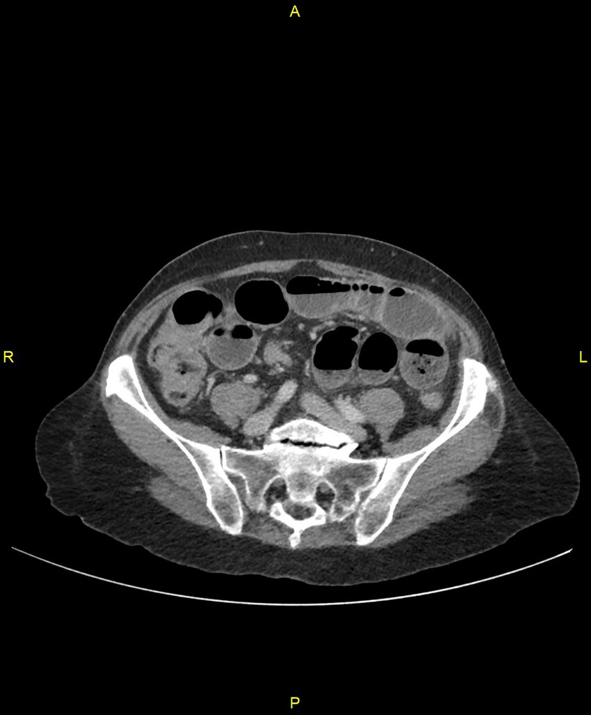 Adhesional small bowel obstruction (Radiopaedia 85402-101024 Axial C+ portal venous phase 198).jpg