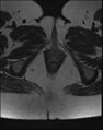 Adnexal multilocular cyst (O-RADS US 3- O-RADS MRI 3) (Radiopaedia 87426-103754 Axial T2 27).jpg