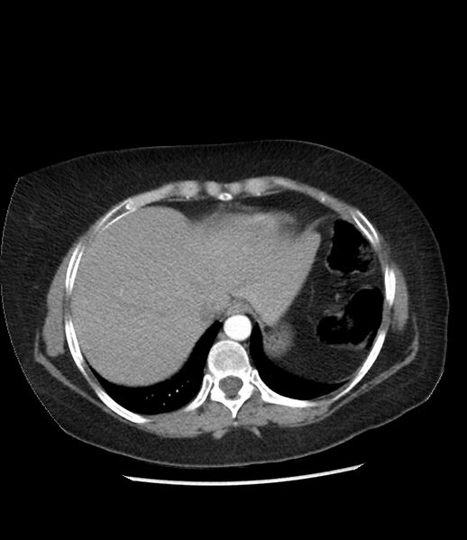 File:Adrenal cortical carcinoma with IVC invasion and thrombosis (Radiopaedia 34307-35597 Axial C+ arterial phase 11).jpg