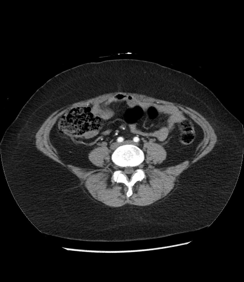 Adrenal cortical carcinoma with IVC invasion and thrombosis (Radiopaedia 34307-35597 Axial C+ arterial phase 57).jpg