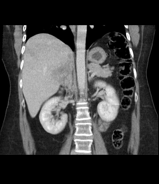 File:Adrenal cortical carcinoma with IVC invasion and thrombosis (Radiopaedia 34307-35597 Coronal C+ portal venous phase 30).jpg