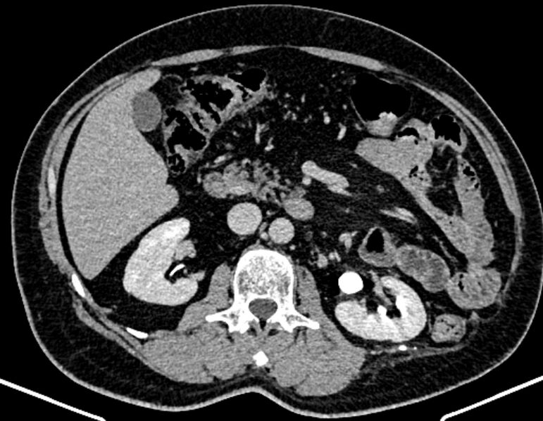 File:Adrenal metastases (Radiopaedia 73082-83791 Axial C+ delayed 144).jpg