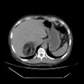 Adrenal myelolipoma (Radiopaedia 41843-44834 Axial non-contrast 8).jpg