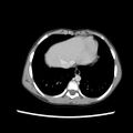 Adrenocortical carcinoma (Radiopaedia 67980).jpg