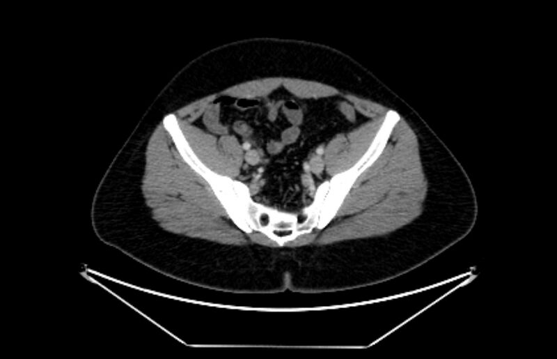 File:Adrenocortical carcinoma (Radiopaedia 80134-93438 Axial C+ portal venous phase 105).jpg