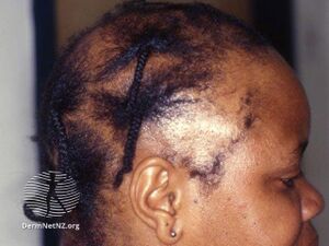 African girl with severe traction alopecia (DermNet NZ hair-nails-sweat-traction-alopecia-3).jpg
