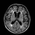 Alzheimer disease (Radiopaedia 10738-11199 Axial FLAIR 13).jpg