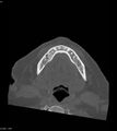 Ameloblastoma (Radiopaedia 18115-17901 Axial bone window 10).jpg