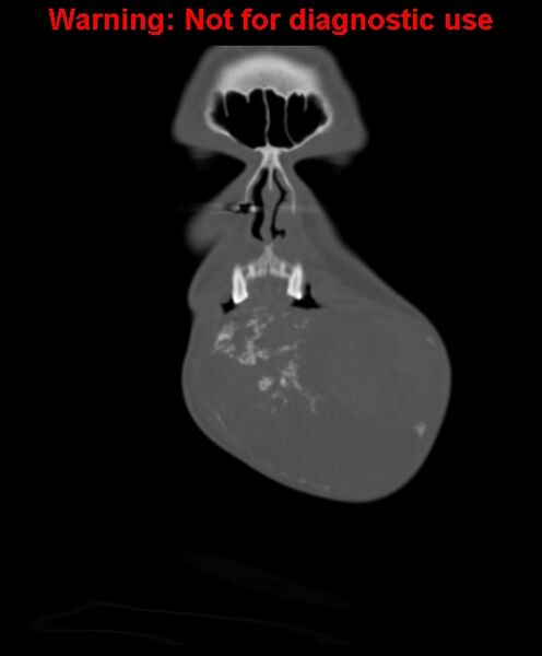 File:Ameloblastoma (Radiopaedia 33126-34164 Coronal bone window 11).jpg