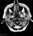 Amyotrophic lateral sclerosis (Radiopaedia 5373-7134 Axial FLAIR 2).jpg