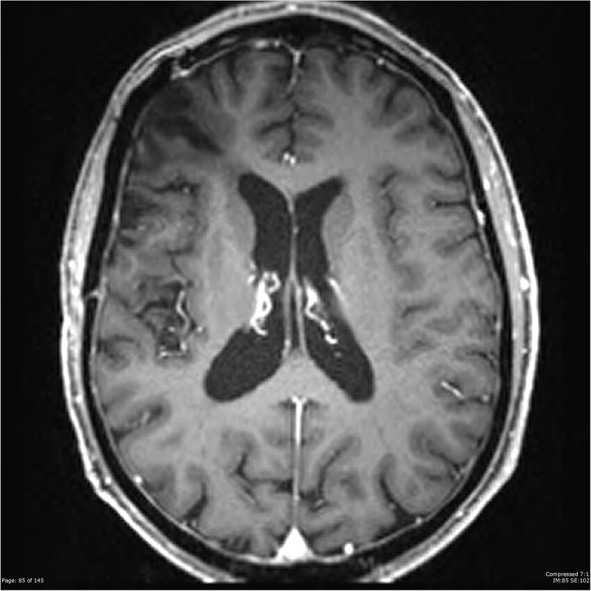 Anaplastic meningioma with recurrence (Radiopaedia 34452-35788 Axial T1 C+ 85).jpg