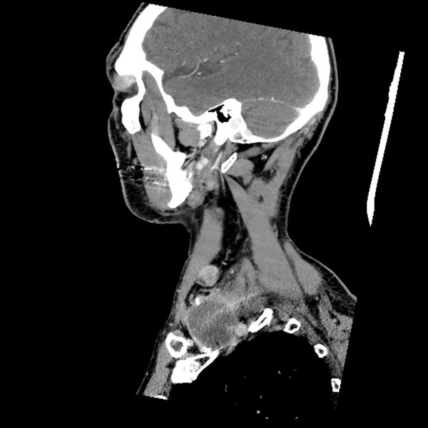 File:Anaplastic thyroid carcinoma (Radiopaedia 79087-92034 C 25).jpg